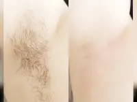 Шугаринг, фотография 2