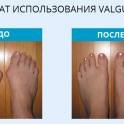 Избавьтесь от косточек на ногах с VALGUS PRO, фотография 3