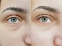 Наращивание ресниц, фотография 2