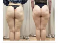 Массаж для похудения, фотография 7