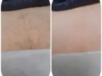 ДепиляцияШугаринг, фотография 3