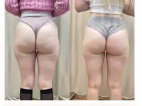 Массаж для похудения, фотография 5
