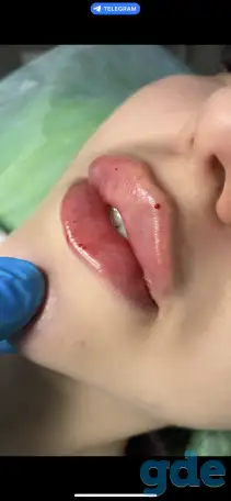 Требуются модели на увеличение губ, фотография 1