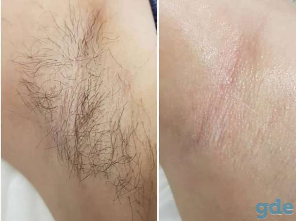 Депиляция сахарной пастой для женщин и мужчин, фотография 3