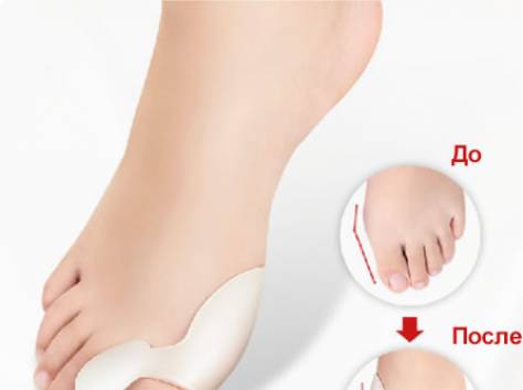 Избавьтесь от косточек на ногах с VALGUS PRO, фотография 2