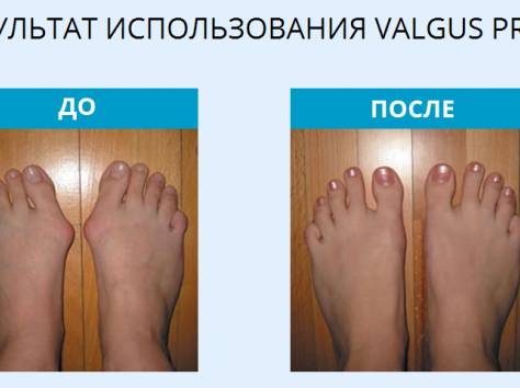 Избавьтесь от косточек на ногах с VALGUS PRO, фотография 3