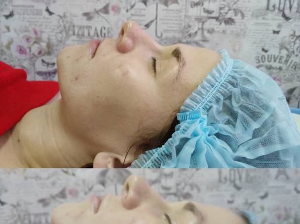 Миофасциальны (пластический) массаж, фотография 2