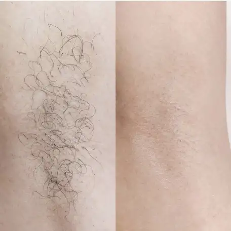 ДепиляцияШугаринг, фотография 2