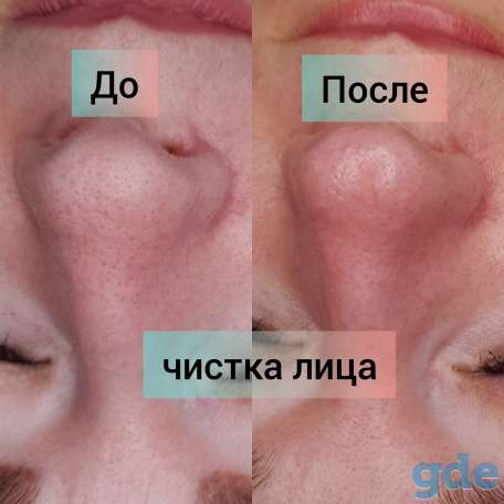 Косметология чистка лица массаж пилинг, фотография 2