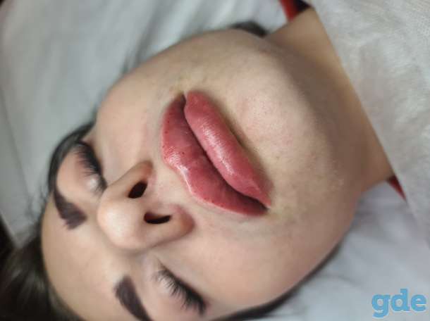 Заполнение морщин/губы, фотография 3