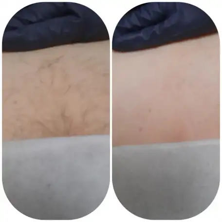 ДепиляцияШугаринг, фотография 3