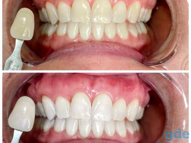 Профессиональное отбеливание зубов, фотография 3