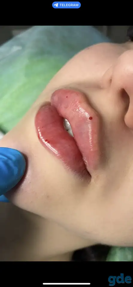 Требуются модели на увеличение губ, фотография 1