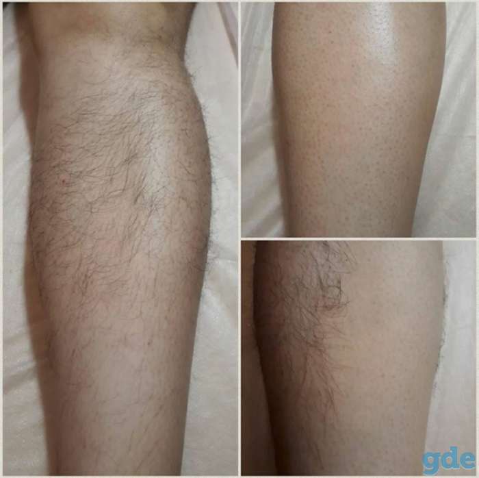 Восковая депиляция, фотография 2