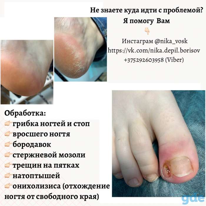 Лечение грибка,удаление бородавок,мозолей, натоптышей, фотография 1