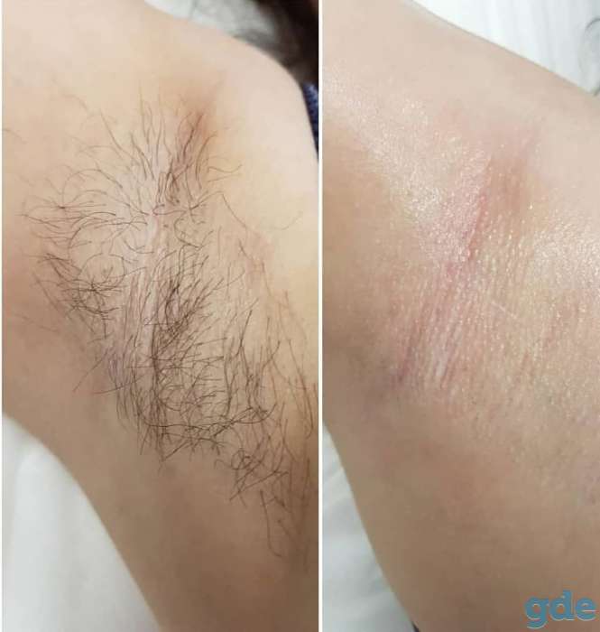 Депиляция сахарной пастой для женщин и мужчин, фотография 3