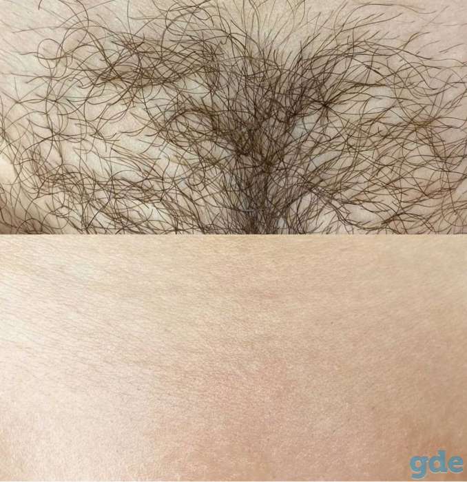 Депиляция сахарной пастой для женщин и мужчин, фотография 4