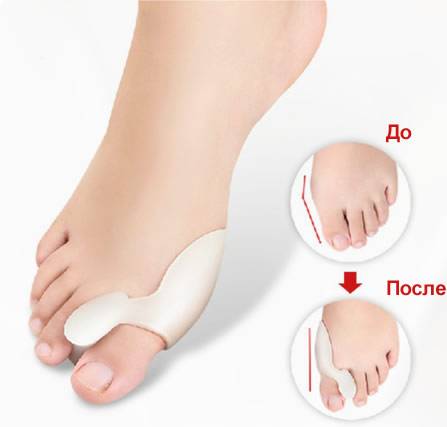 Избавьтесь от косточек на ногах с VALGUS PRO, фотография 2