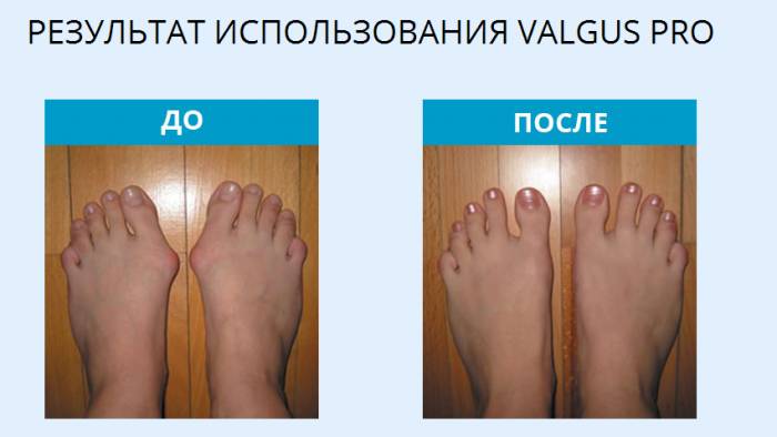 Избавьтесь от косточек на ногах с VALGUS PRO, фотография 3