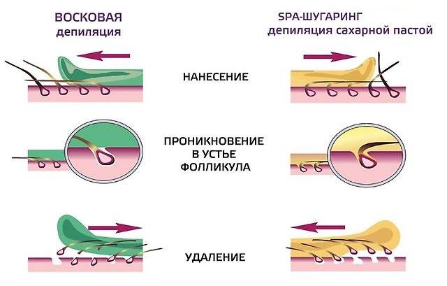 Шугаринг. Депиляция воском, фотография 2
