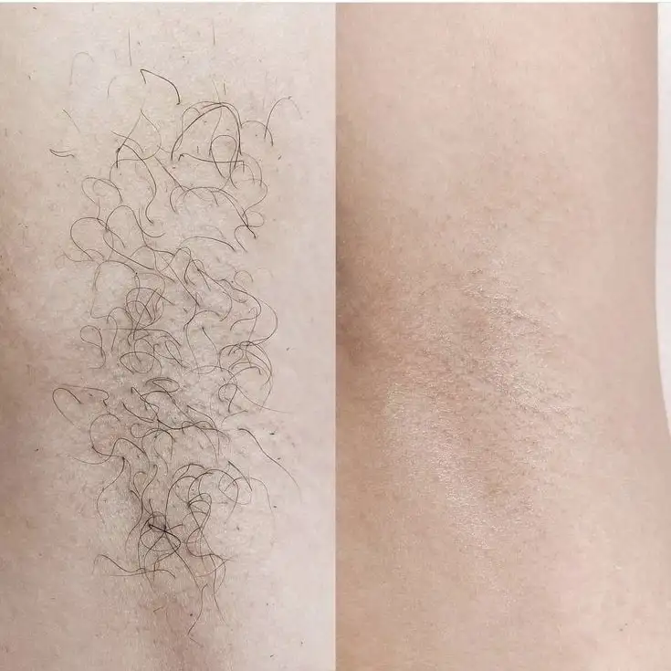 ДепиляцияШугаринг, фотография 2