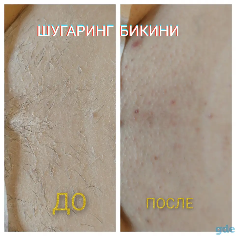 Шугаринг, фотография 2