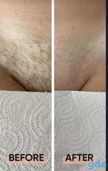 Депиляция, фотография 2