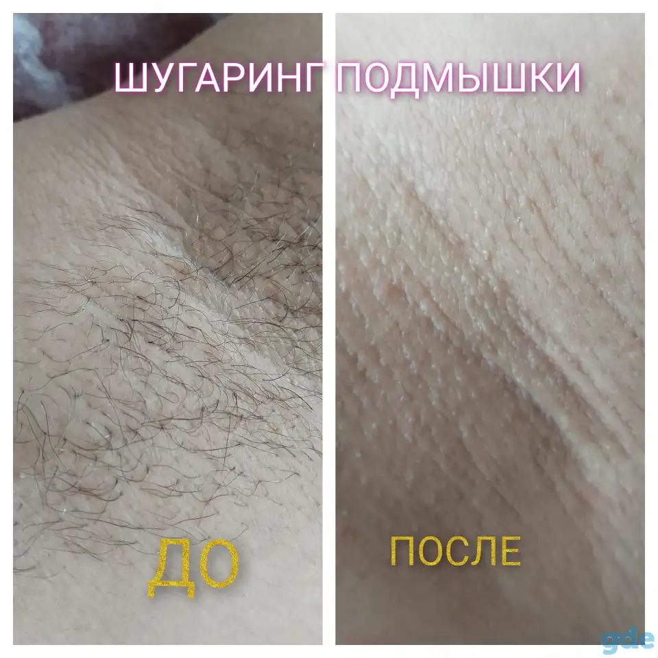 Шугаринг, фотография 3