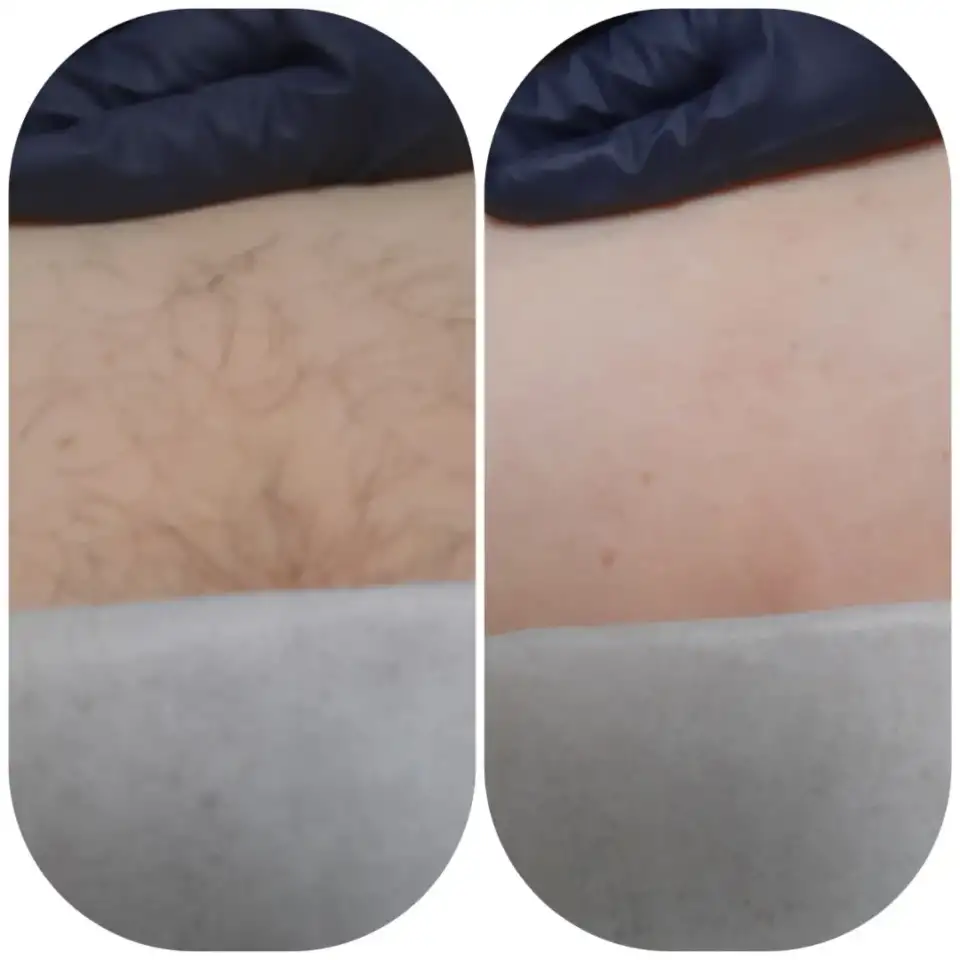 ДепиляцияШугаринг, фотография 3