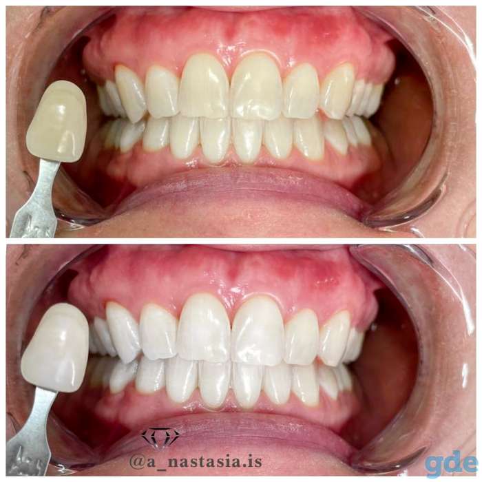 Профессиональное отбеливание зубов, фотография 3